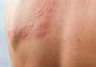 Herpes-Zóster: Sintomas, Prevenção e Aumento dos Casos no Pós-Pandemia
